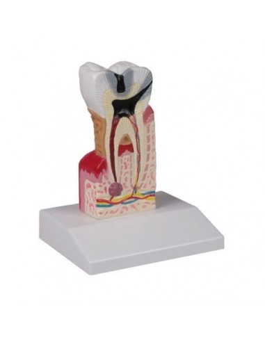 Modelo anatómico de um dente cariado,...