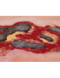 Moulage de ferida de úlcera... 2