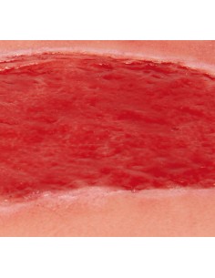 Moulage de ferida de úlcera... 2