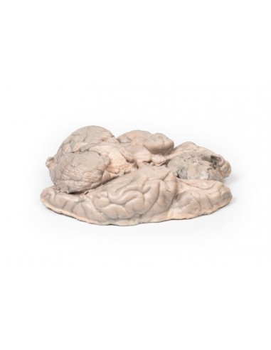 Meningioma - Erler Zimmer Série de...