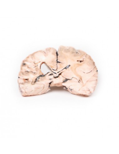 Enfarte cerebral esquerdo - Erler...