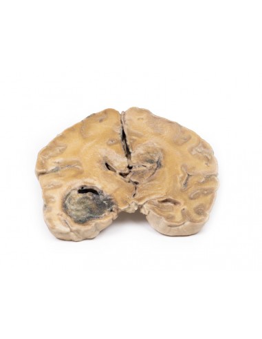 Glioblastoma multiforme - Série de...