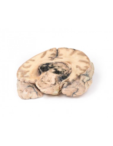 Glioblastoma multiforme - Série de...