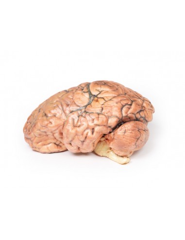 Craniofaringioma - Série de anatomia...