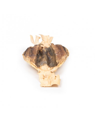 Aneurisma da aorta abdominal - Erler...