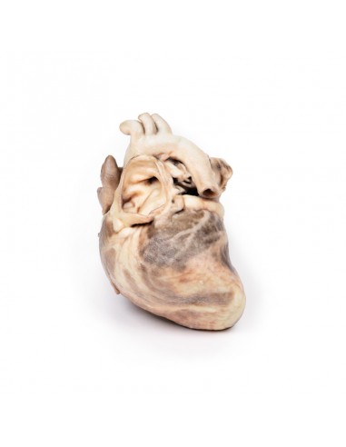 Estenose pulmonar congénita - Erler...
