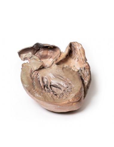 Aneurisma da aorta torácica roto -...