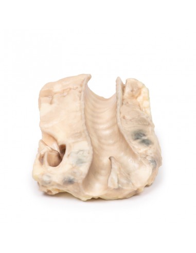 Traqueia: Linfoma de Hodgkin - Erler...